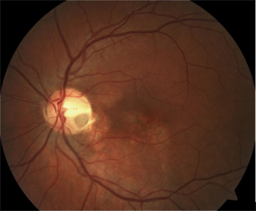 Central Serous Chorioretinopathy