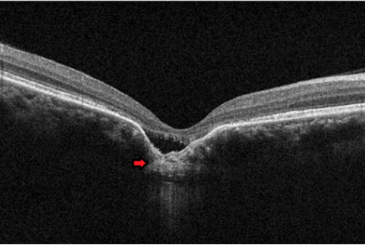 Central Serous Chorioretinopathy