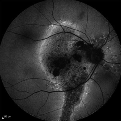 Central Serous Chorioretinopathy