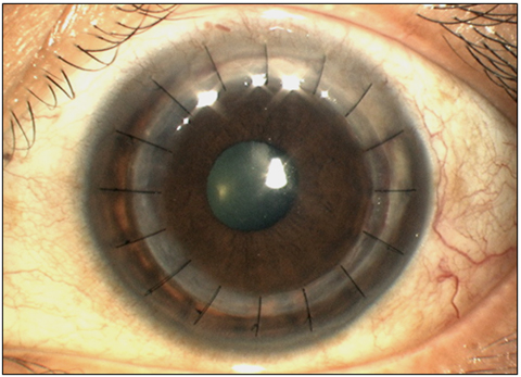 Corneal Surgery