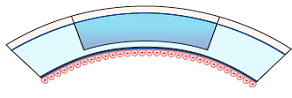 Corneal Surgery