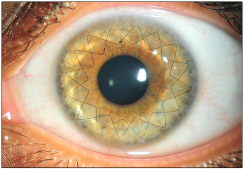 Corneal Surgery