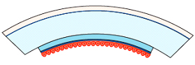 Corneal Surgery