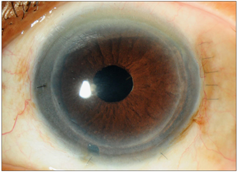 Corneal Surgery