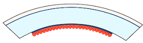 Corneal Surgery