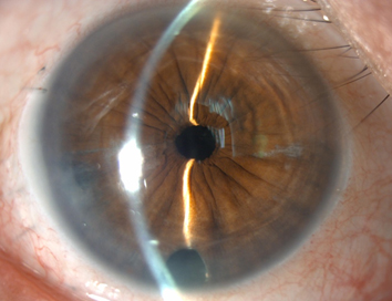 Corneal Surgery