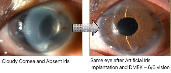 Corneal Surgery