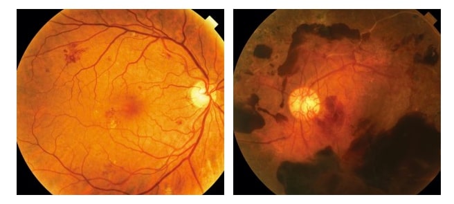 Diabetic Retinopathy Screening