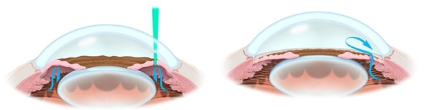 Laser Peripheral Iridotomy