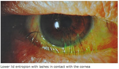 Oculoplastic Conditions