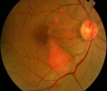 Polypoidal Choroidal Vasculopathy (PCV)