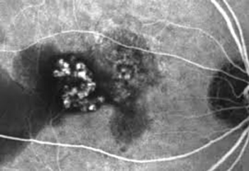 Polypoidal Choroidal Vasculopathy (PCV)