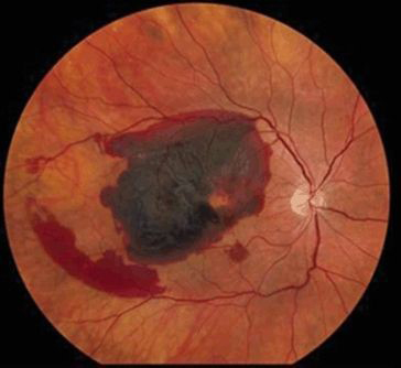 Polypoidal Choroidal Vasculopathy (PCV)