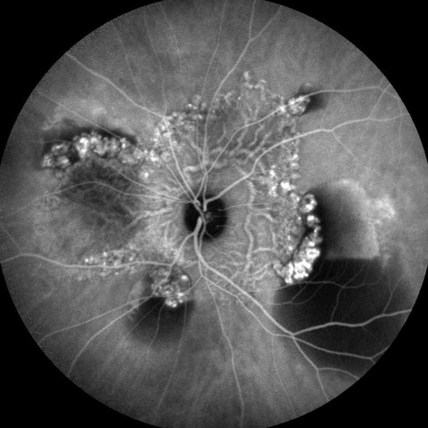 Polypoidal Choroidal Vasculopathy (PCV)