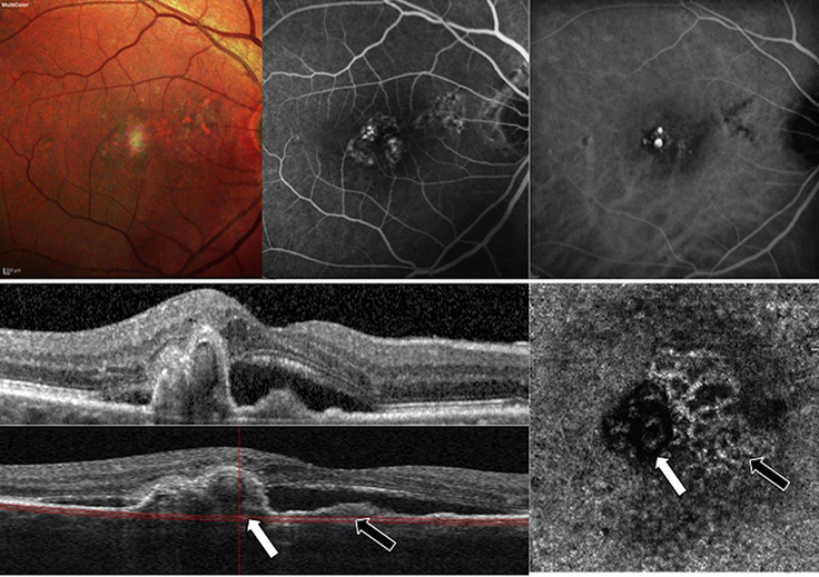 Polypoidal Choroidal Vasculopathy (PCV)