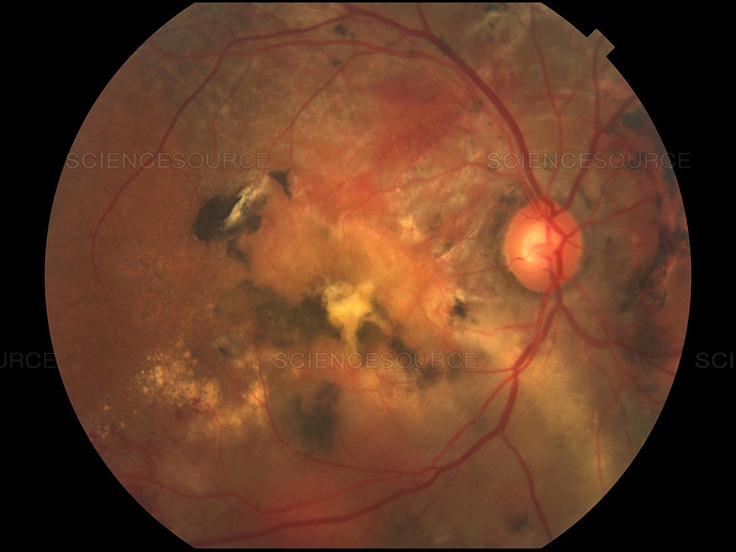 Polypoidal Choroidal Vasculopathy (PCV)