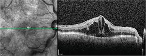 Retinal Venous Occlusive Disease