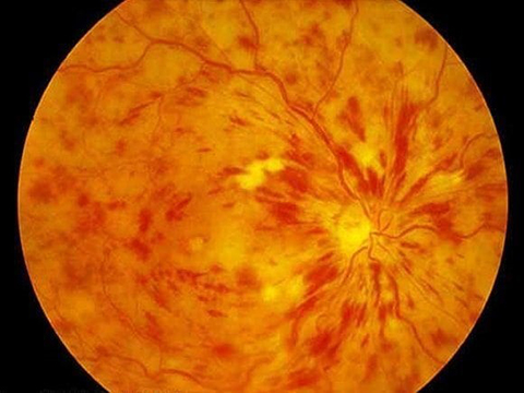 Retinal Venous Occlusive Disease