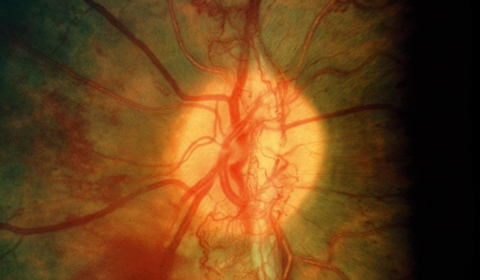 Retinal Venous Occlusive Disease