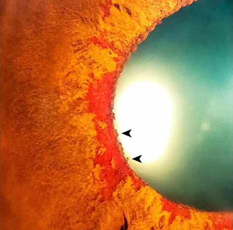 Retinal Venous Occlusive Disease