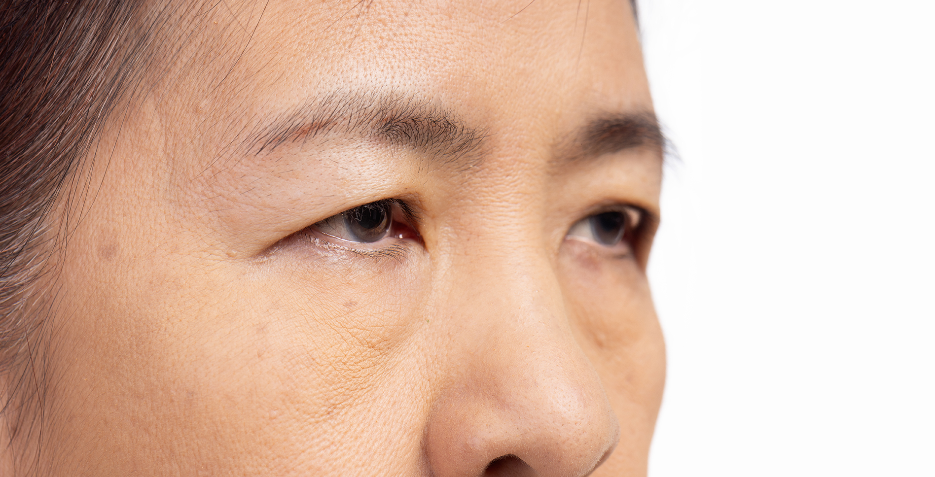 Woman with droopy eyelids, showing signs of eyelid heaviness.