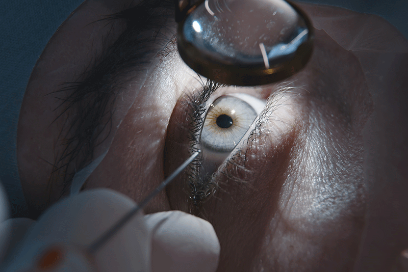 Close-up of a patient’s eye during laser vision correction surgery.